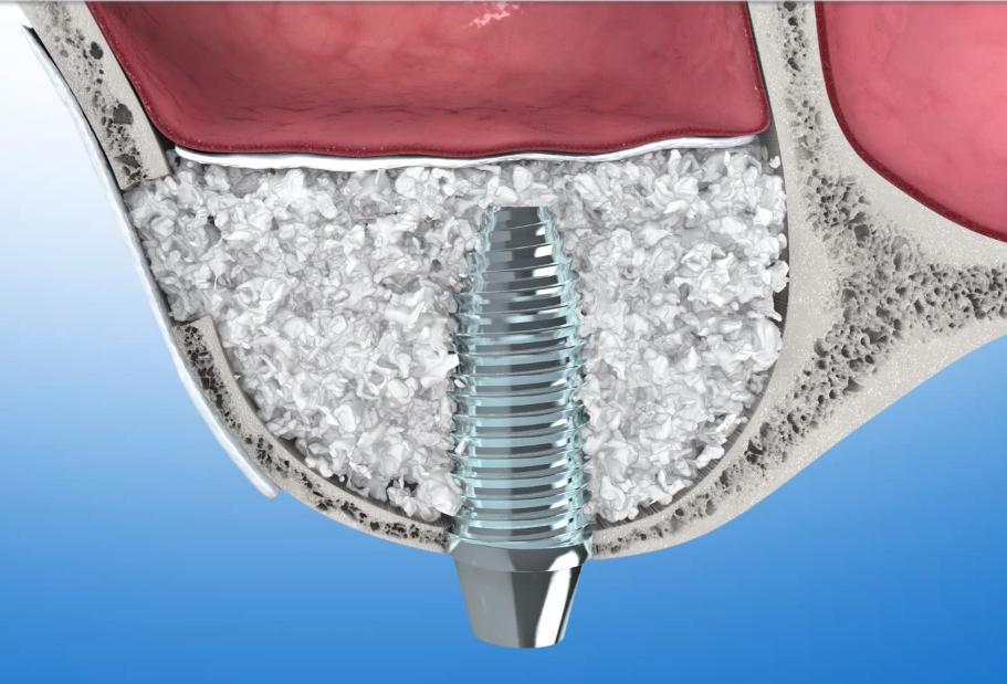 Ispovremena postava implantata sa podizanjem dna sinusa i augmentacijom kosti