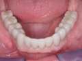 All-on-four-dental-implant-3