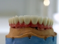 all-on-6-zagreb-dental-2