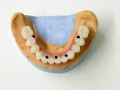 all-on-6-zagreb-dental-4