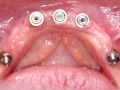 all-on-6-zagreb-dental-7