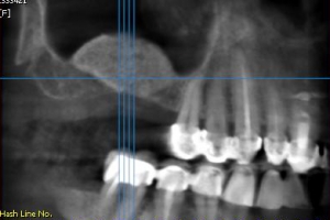 zubni_dentalni_implantat__sinus_lift_3.jpg