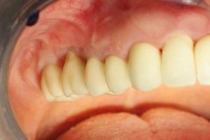 zubni_dentalni_implantat__sinus_lift_5.jpg
