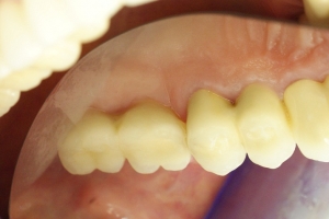 zubni_dentalni_implantat__sinus_lift_6