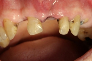 Pokvareni i uništeni zubi