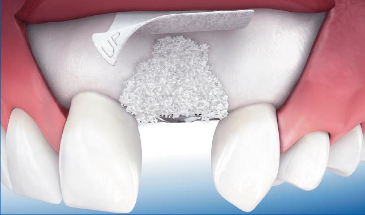 Koštana augmentacija na prednjim zubima
